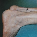 Le lesioni del tendine d’Achille….. quel famoso punto debole!!! image-16461